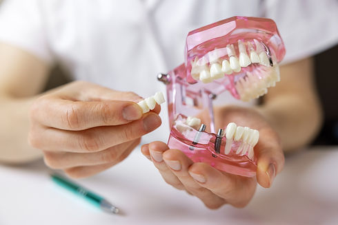 dentiste implantologue montrant la technologie d'implantation de ponts dentaires sur un mo