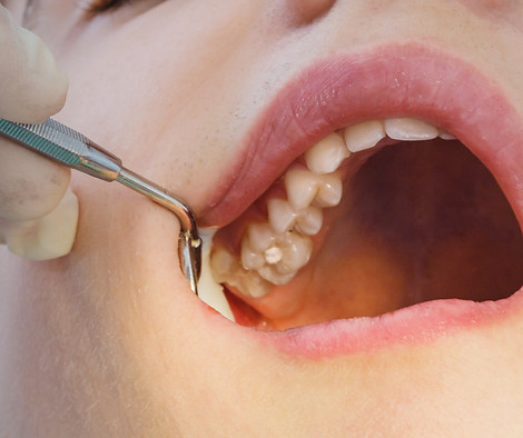 Dental treatment for tooth filling in the dental clinic