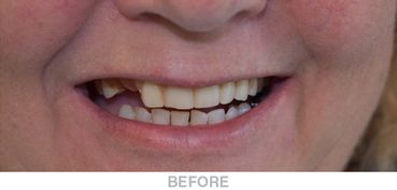 Complete-U-and-Partial-L-Denture-Before