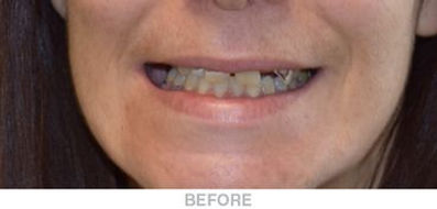 Complete-Upper-Surgical-Dentures-Before