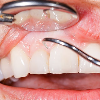 Gum-Disease-Treatment-Jackson-MS.jpg