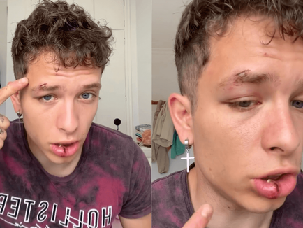 Brutalny atak na tle homofobicznym dotknął włoskiego influencera Joe De La Torre, znanego z treści publikowanych na platformach OnlyFans oraz TikTok.