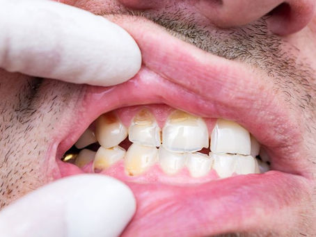 How Fast Can a Dentist Fix a Broken Tooth?