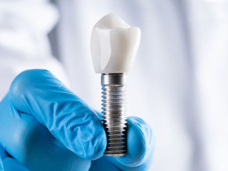 Are Dental Implants Safe for My Long-Term Oral Health?