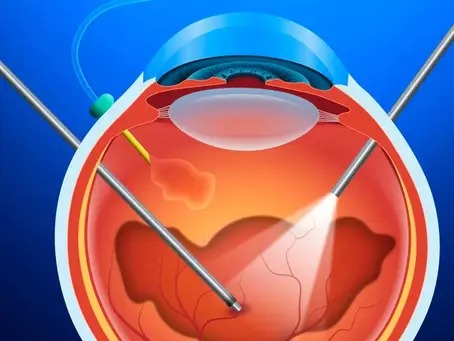 Vitrectomia e Suas Indicações de Forma Prática