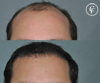transplante-capilar-antes-e-depois-clinica_franca.webp