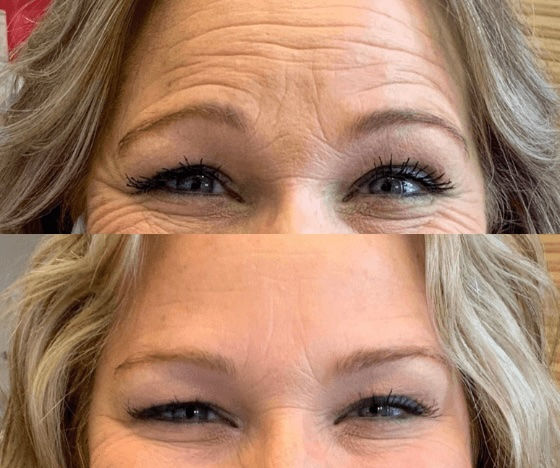 Before and after results of cheek and chin balancing treatment at Artox Aesthetics in Rockwall, TX