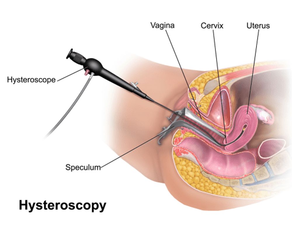 Hysteroscopy used for viewing uterine polyps