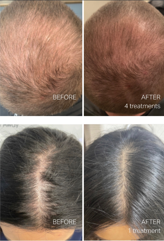 NEW Hydrafacial Scalp Treatment