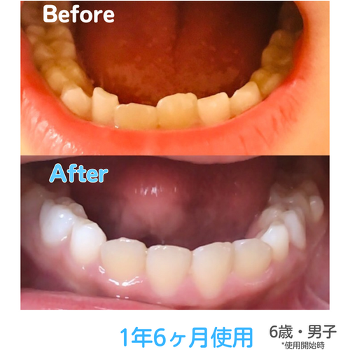 ミロクマウスピース（369mouthpiece） | Prosper Beauty Shop