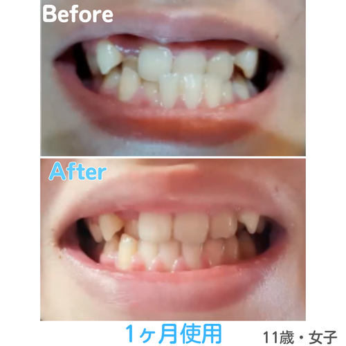 ミロクマウスピース（369mouthpiece） | Prosper Beauty Shop