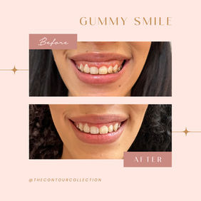 Gummy Smile - Client was treated with 5 units of Botox. This photo highlights a visible decrease in upper gum exposure when smiling.