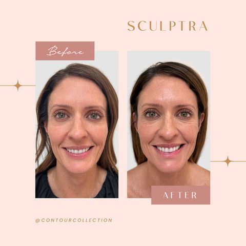 Sculptra Before & After
