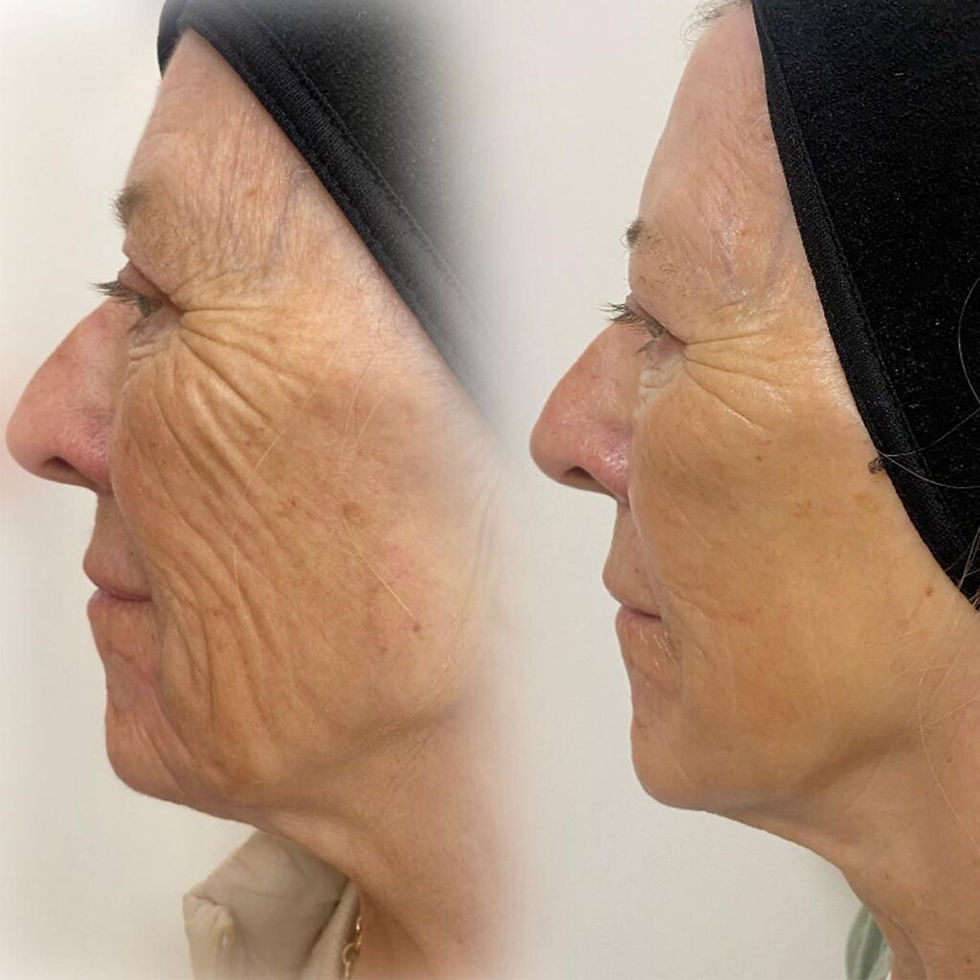 Considering Neogen? Here’s What to Expect from Treatment