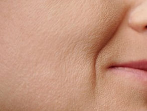 法令紋位移了怎麼辦