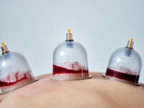 BEL AĞRISI VE KUPA TERAPİSİ (HACAMAT)