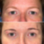 Brow Lift