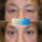 Ptosis Repair