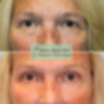 Brow Lift