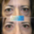 Lower Eyelid Blepharoplasty