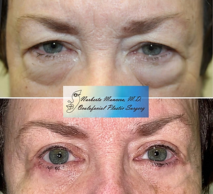 Blepharoplasty