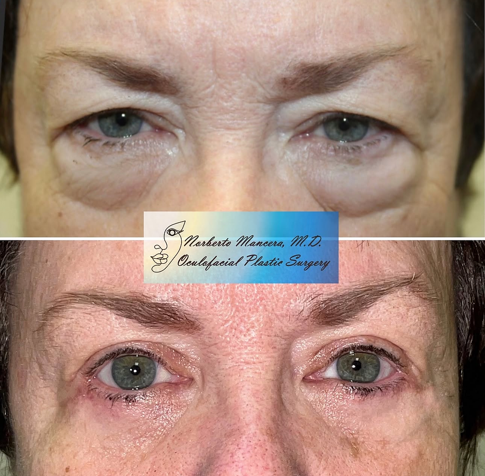 Lower Eyelid Blepharoplasty
