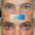 Lower Eyelid Blepharoplasty