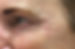 crowsfeetpatient2.jpg