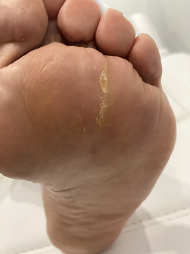 Running Fix - Callous.HEIC