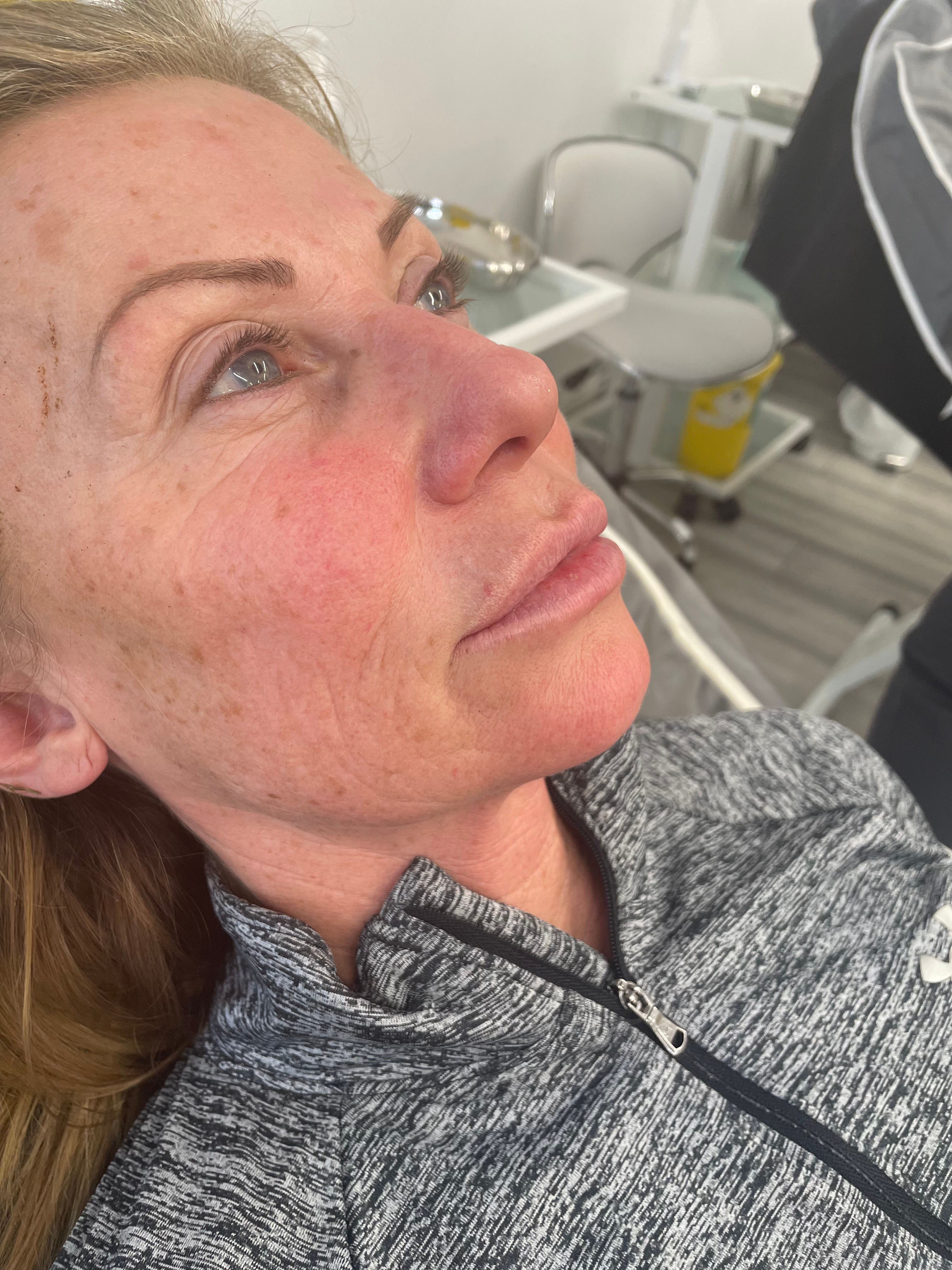 Nasal folds treatment in Rainham, Essex at Eye Me Up Aesthetics