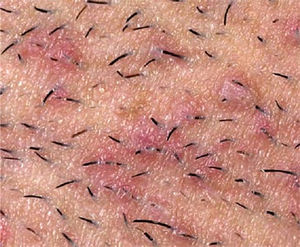 Ingrown Hairs And How To Prevent Them