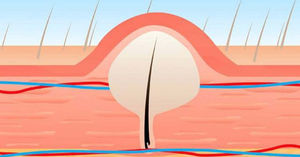 Ingrown Hairs And How To Prevent Them