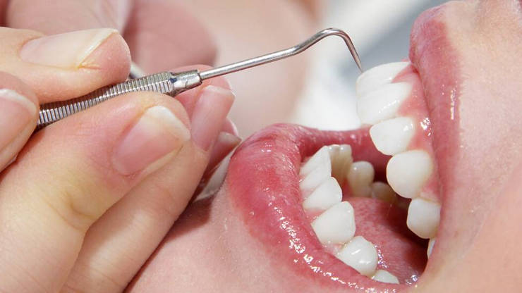 Sparkling smile after professional dental cleaning in Dubai