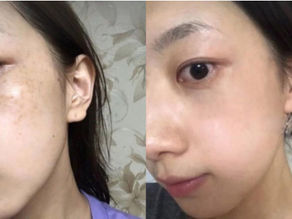 Điều trị tàn nhang chuyên sâu giúp da sáng đều màu tự nhiên