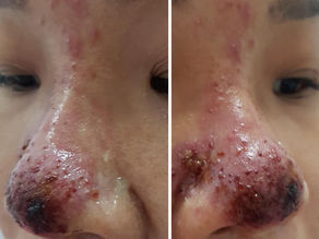 Tại sao không nên tiêm filler mũi