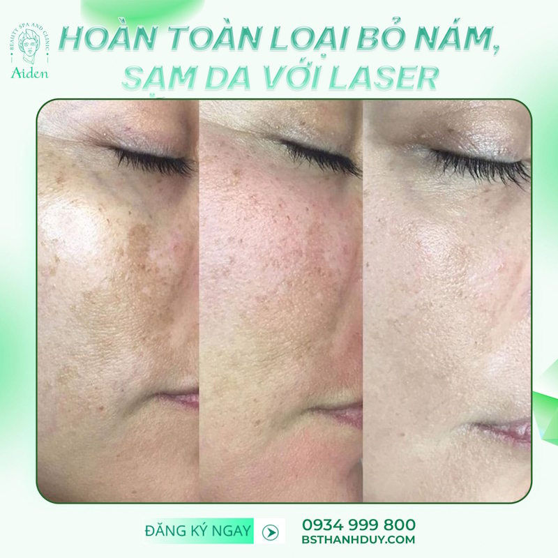 Picosecond Laser treatment for melasma