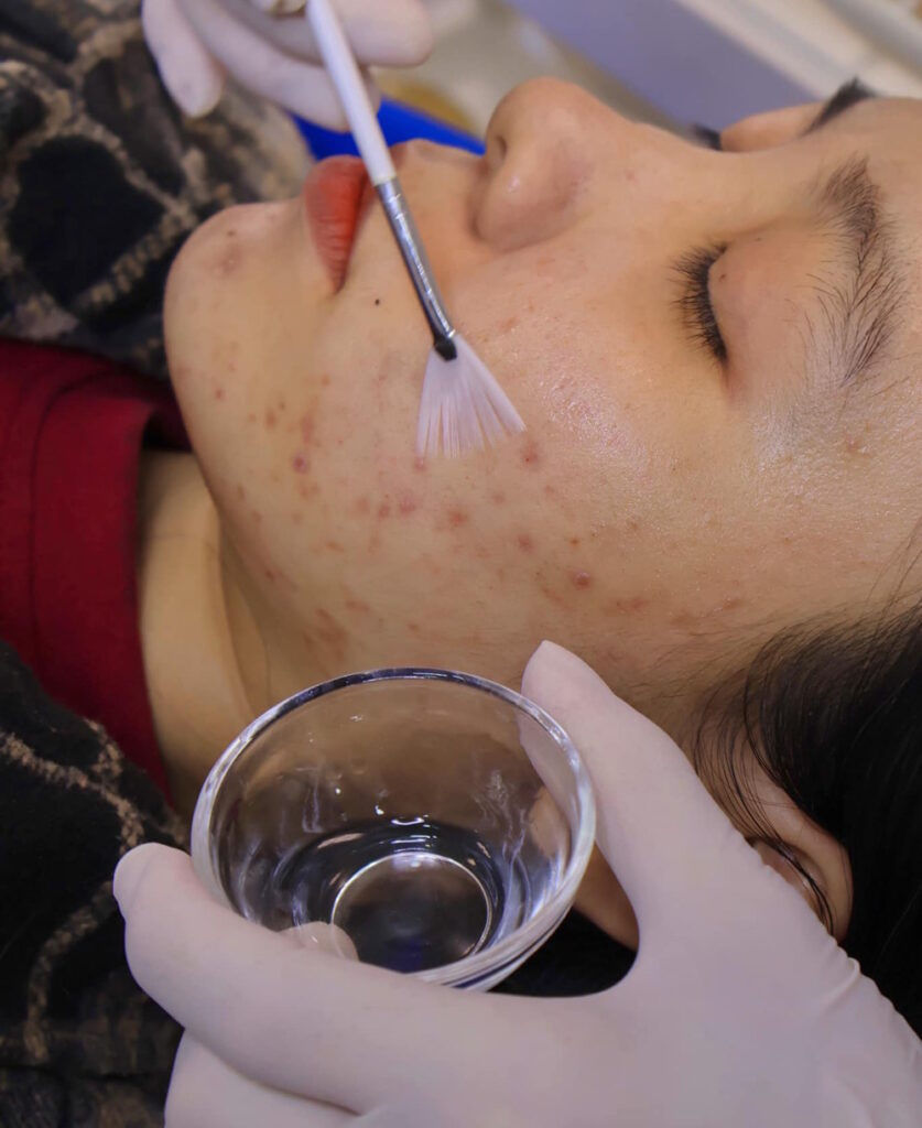 peel da chăm sóc da