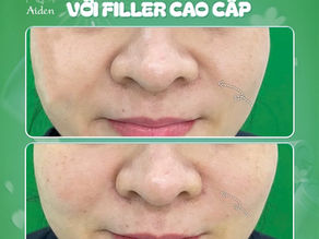 Làm đầy rãnh hố lê an toàn | Tiêm filler trẻ hóa tự nhiên