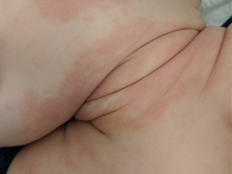 Beat Heat Rash in 7 easy ways