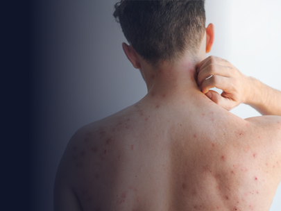 Sarampión en alerta: Colombia se prepara ante el riesgo internacional por el Mundial 2026