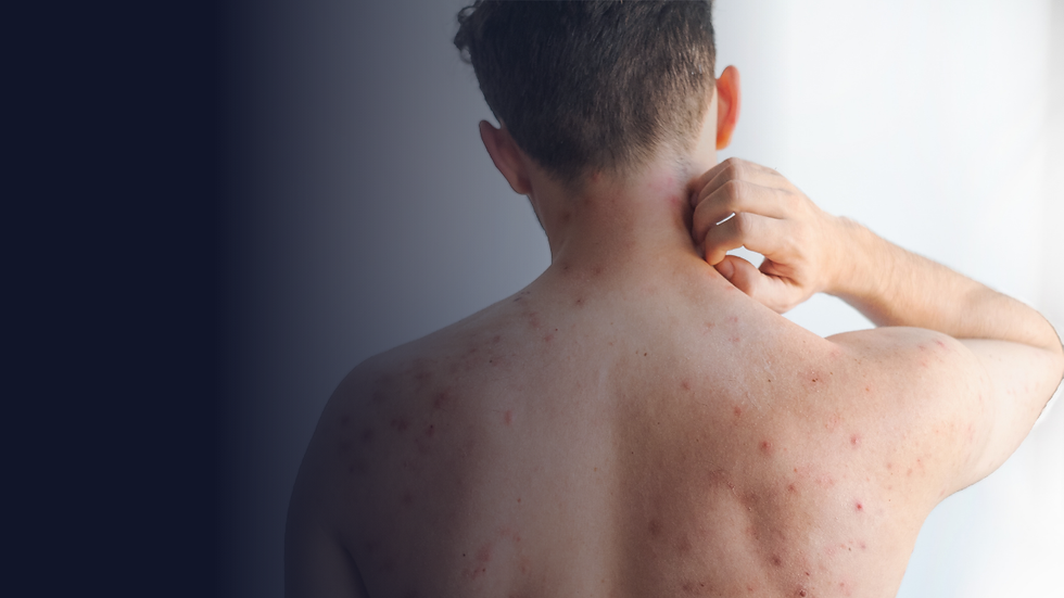 Sarampión en alerta: Colombia se prepara ante el riesgo internacional por el Mundial 2026