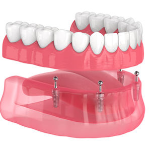 Implant Supported Denture