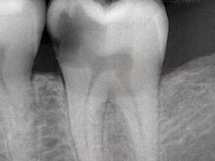 X-ray showing decay to pulp