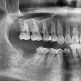 Dental X-ray showing the site of tooth #47 after extraction.