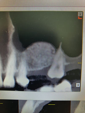Implant2.jpeg