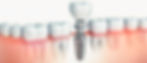 dental implant.jpeg