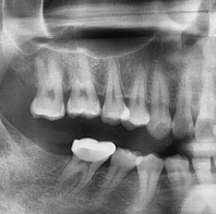🦷 Implant Timing: When to Replace a Removed Tooth | Dental Lounge Guide (Why Timing Matters More Than You Think)