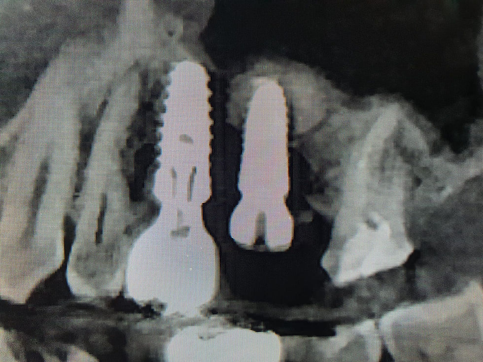 Implant after placement