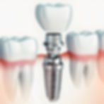 Dental implant with prosthic