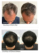 Fotona Hairrestart الصور قبل وبعد